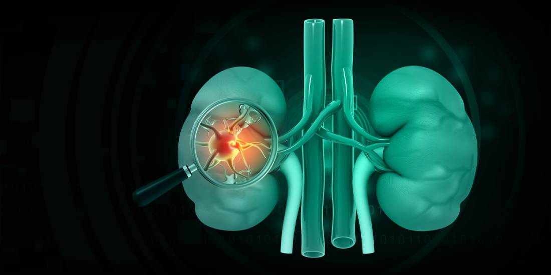 Featured image for How to Prevent Kidney Failure