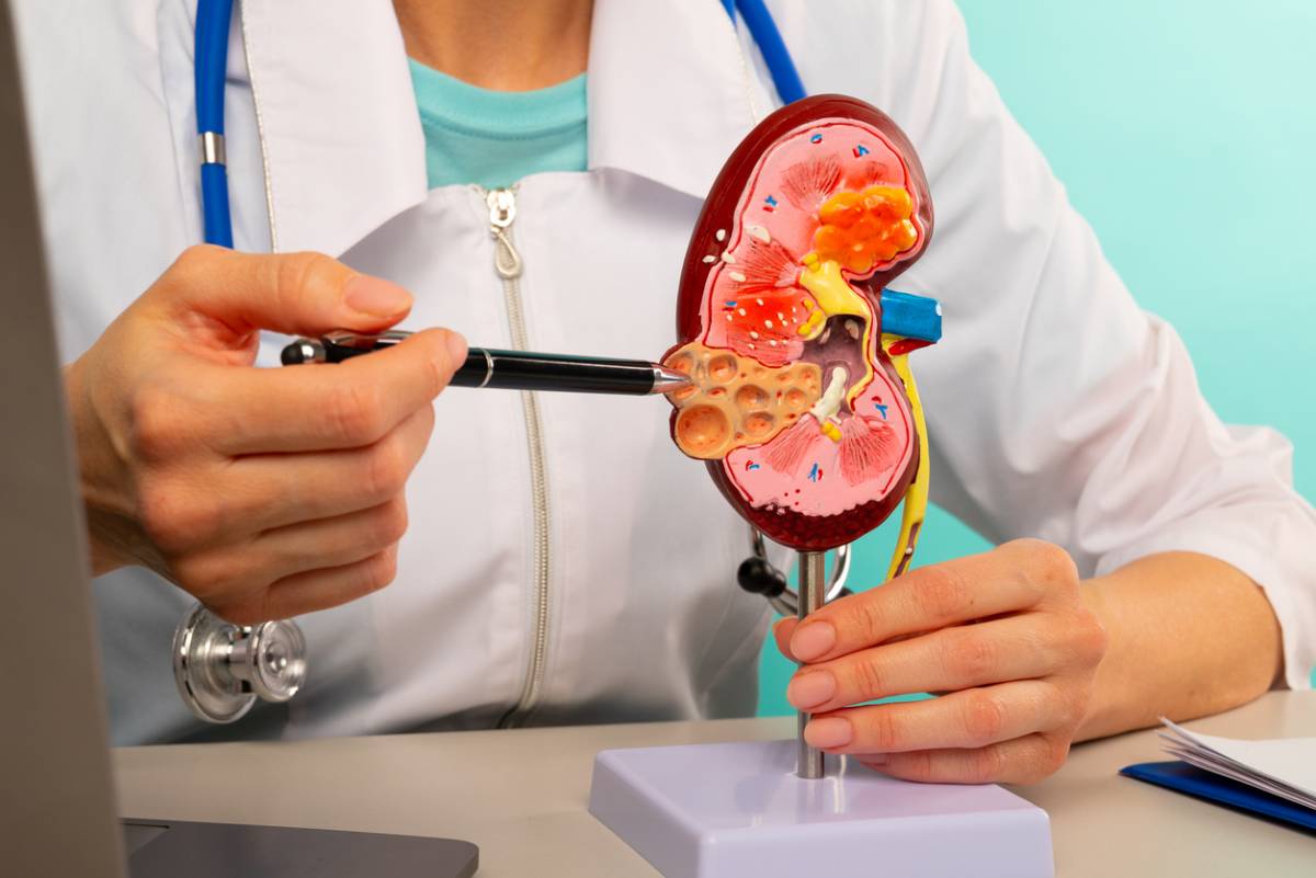 Featured image for What Do Kidney Stones Feel Like?